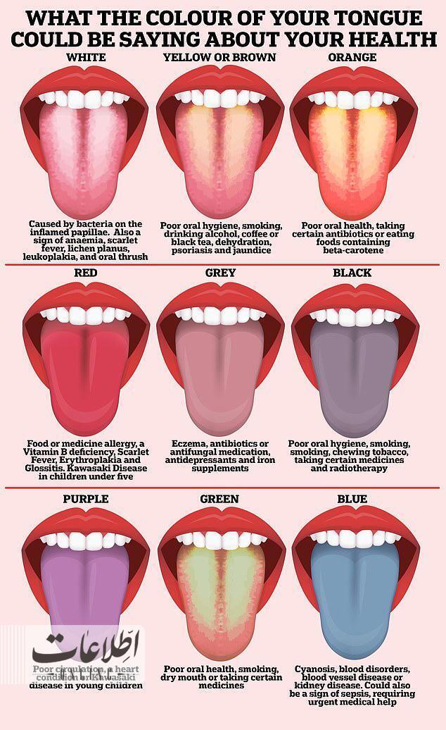 زبان سالم چه رنگی است و رنگ‌های مختلف نشانه کدام بیماری‌هاست؟ +عکس